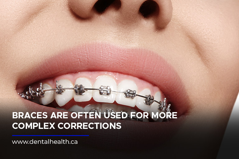 Braces are often used for more complex corrections