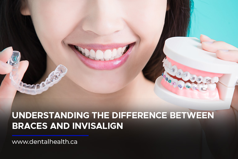 Understanding the Difference Between Braces and Invisalign