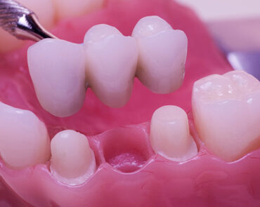 Dental Bridge Services Kingsway family dental