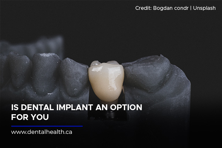 Is Dental Implant an Option for You?
