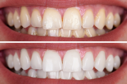 Teeth Whitening Services Kingsway Family Dentistry Beamsville