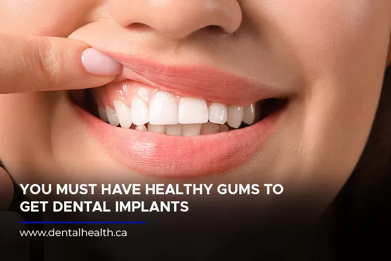 You-must-have-healthy-gums-to-get-dental-implants