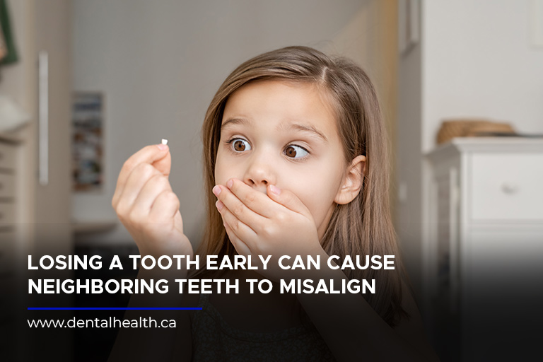 Losing a tooth early can cause neighboring teeth to misalign