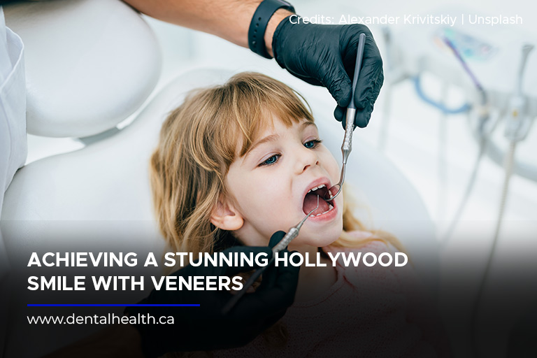 Achieving a Stunning Hollywood Smile With Veneers