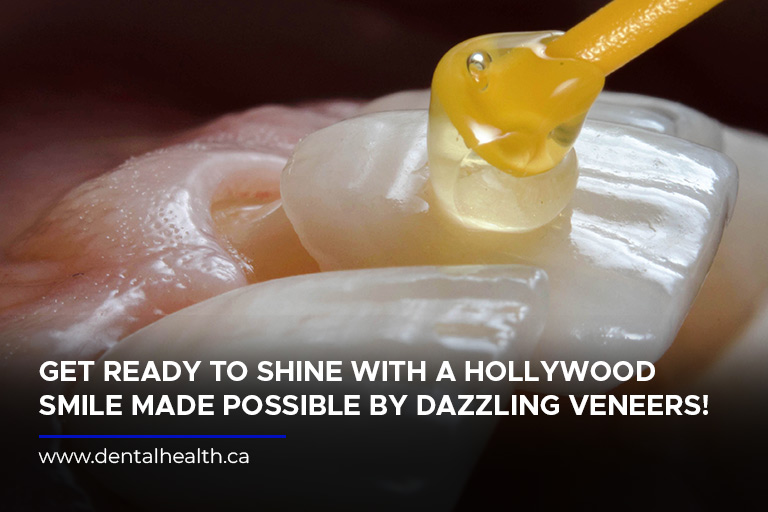 Get ready to shine with a Hollywood smile made possible by dazzling veneers!