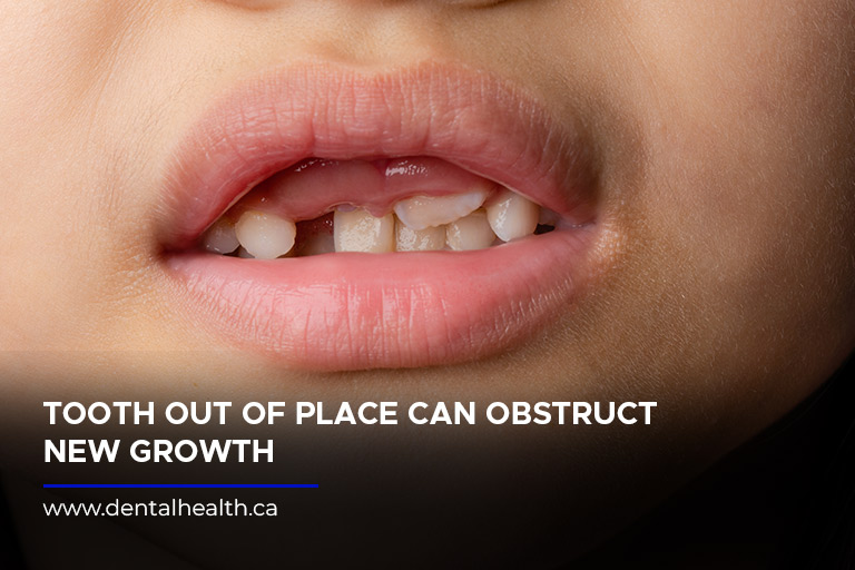 Tooth out of place can obstruct new growth