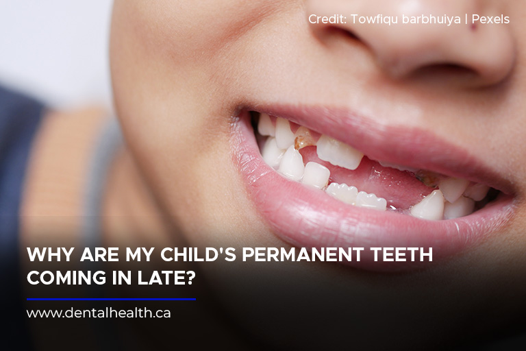 Why Are My Childs Permanent Teeth Coming In Late?