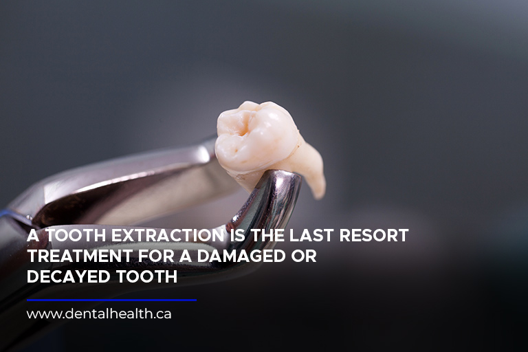 A tooth extraction is the last resort treatment for a damaged or decayed tooth