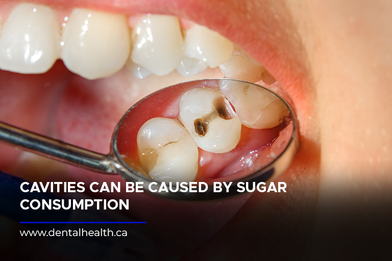 Cavities can be caused by sugar consumption