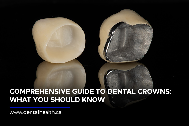 Comprehensive Guide to Dental Crowns: What You Should Know