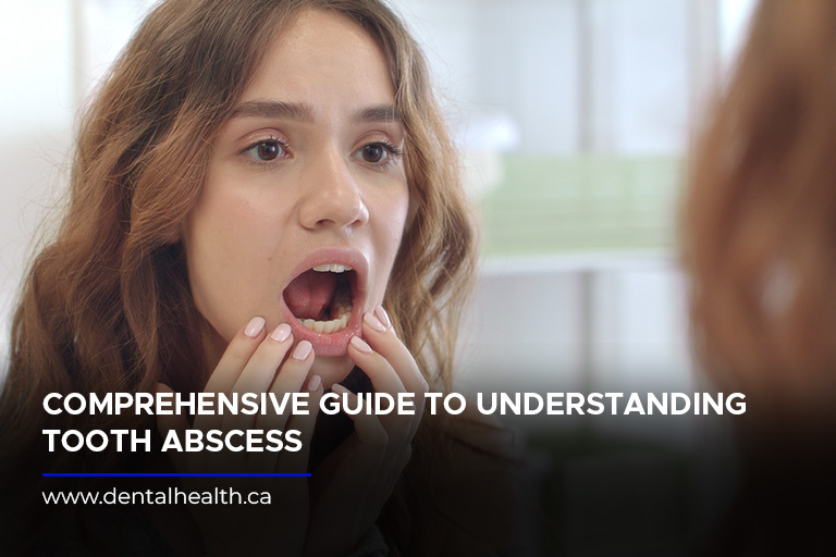 Comprehensive Guide to Understanding Tooth Abscess