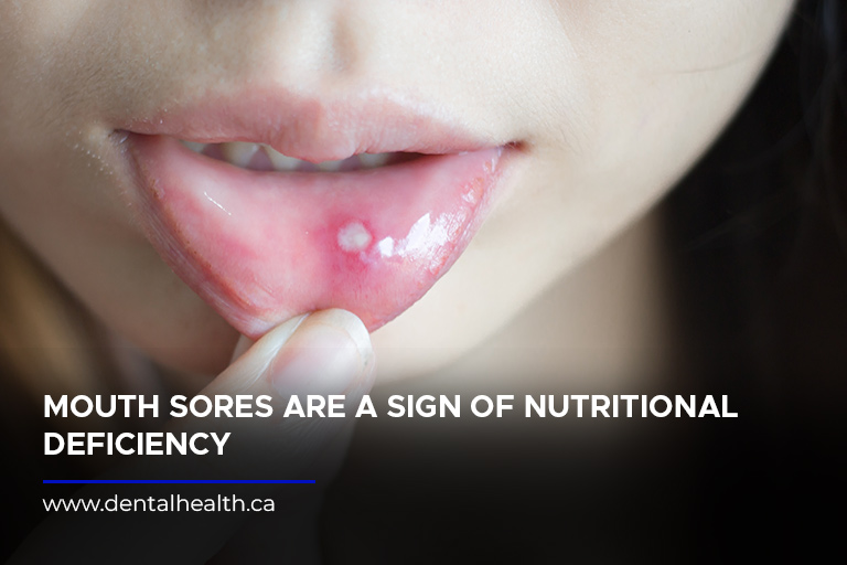 Mouth sores are a sign of nutritional deficiency