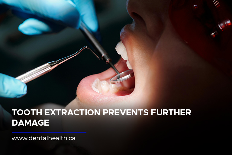 Tooth extraction prevents further damage