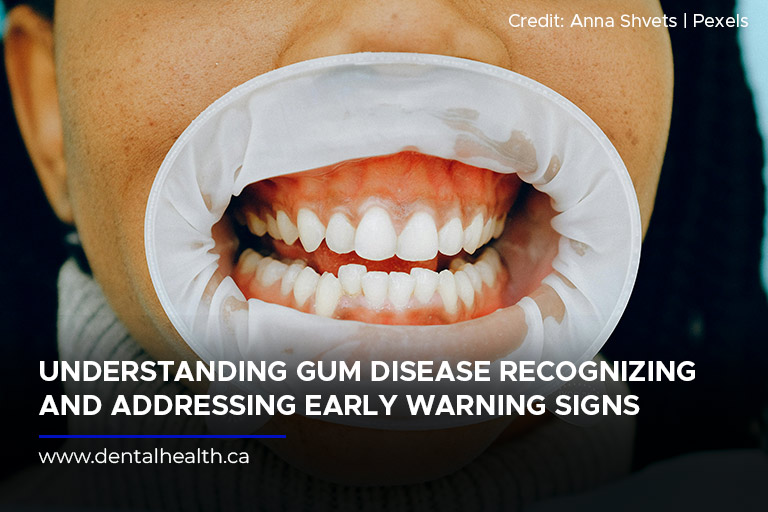 Understanding Gum Disease Recognizing and Addressing Early Warning Signs