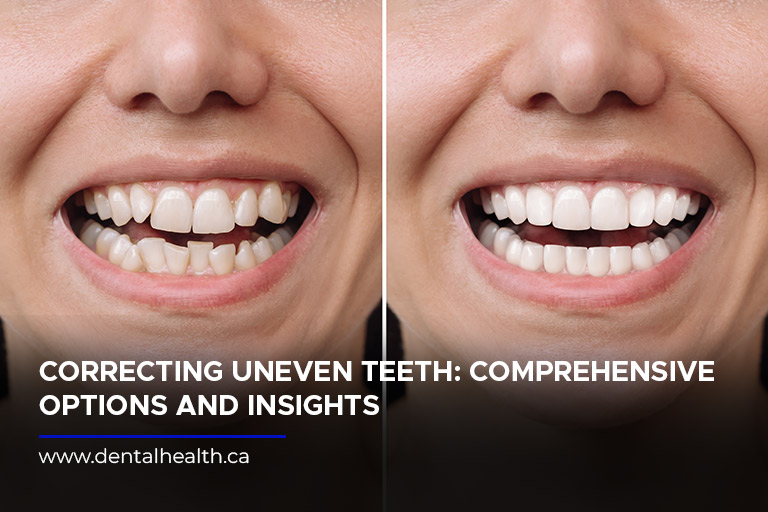 Correcting Uneven Teeth: Comprehensive Options and Insights