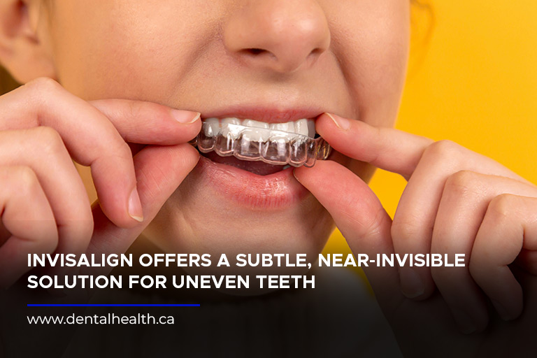 Invisalign offers a subtle, near-invisible solution for uneven teeth
