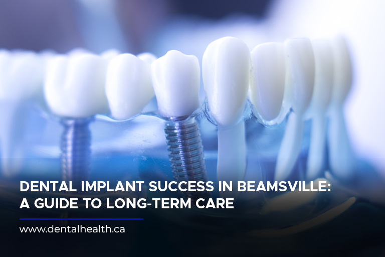 Dental Implant Success in Beamsville: A Guide to Long-Term Care