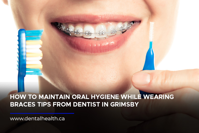 How to Maintain Oral Hygiene While Wearing Braces Tips from Dentist in Grimsby