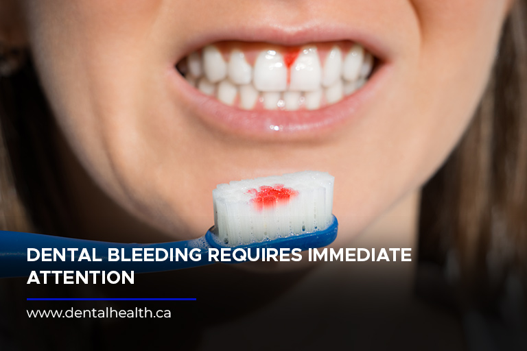 Dental bleeding requires immediate attention