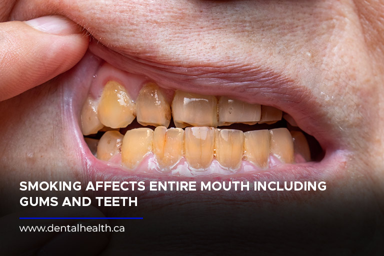 Smoking affects entire mouth including gums and teeth