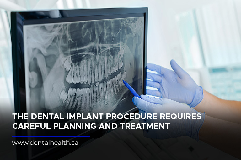 The dental implant procedure requires careful planning and treatment