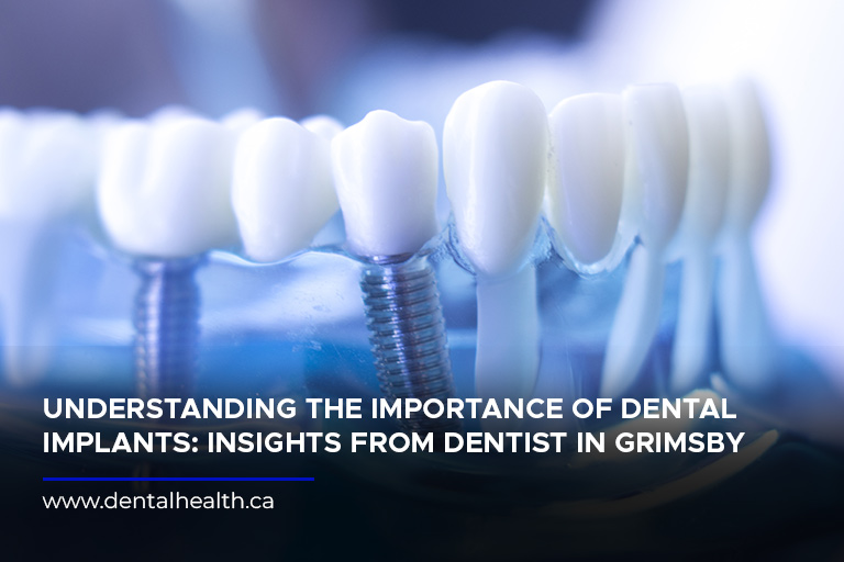 Understanding the Importance of Dental Implants: Insights from Dentist in Grimsby