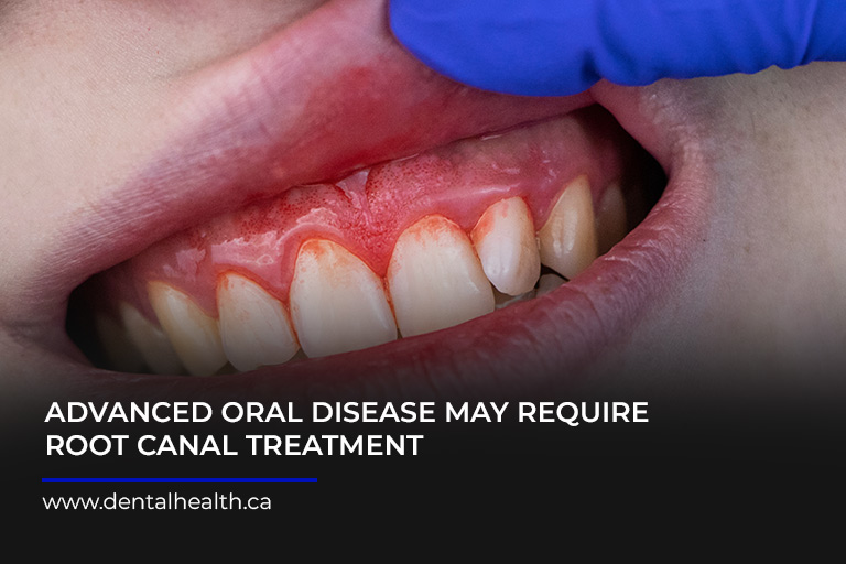 Advanced-oral-disease-may-require-root-canal-treatment