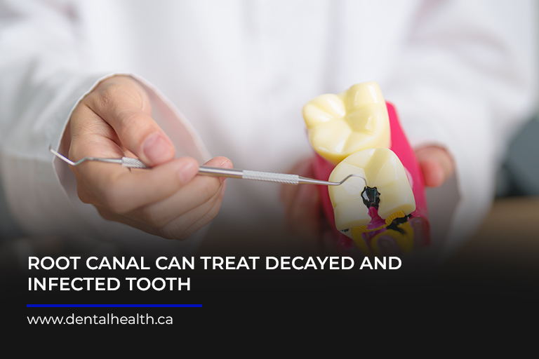 Root-canal-can-treat-decayed-and-infected-tooth