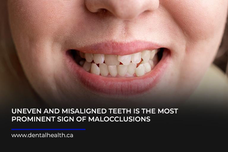 Uneven-and-misaligned-teeth-is-the-most-prominent-sign-of-malocclusions