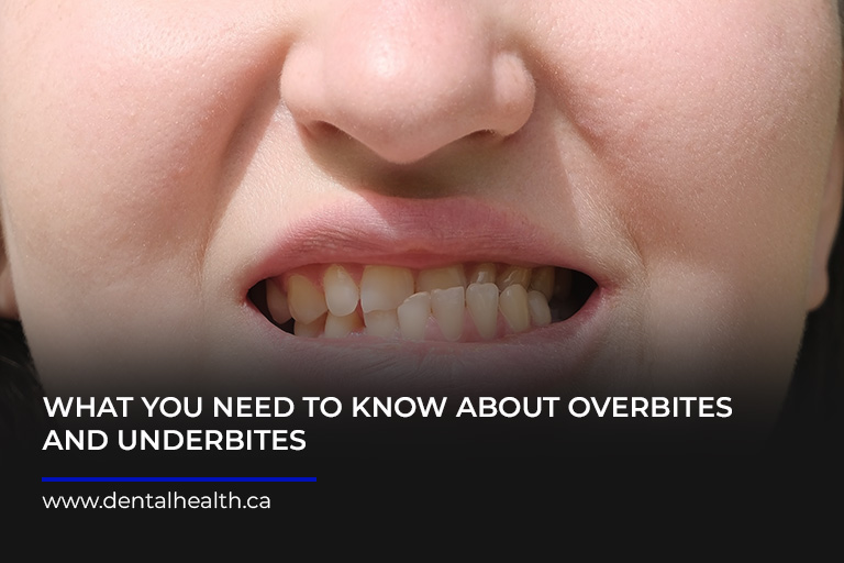 What You Need to Know About Overbites and Underbites - Kingsway Dental Health