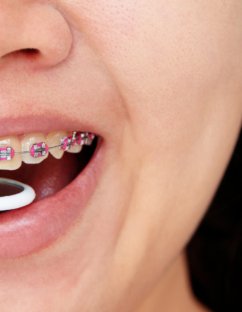 braces