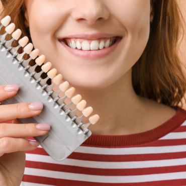Veneers