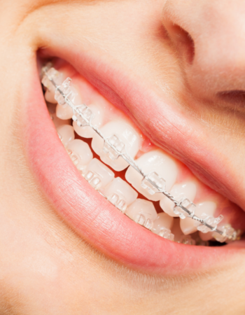 ceramic braces
