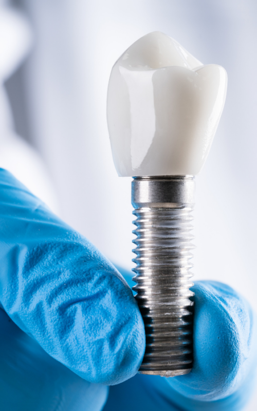 Dental Implants