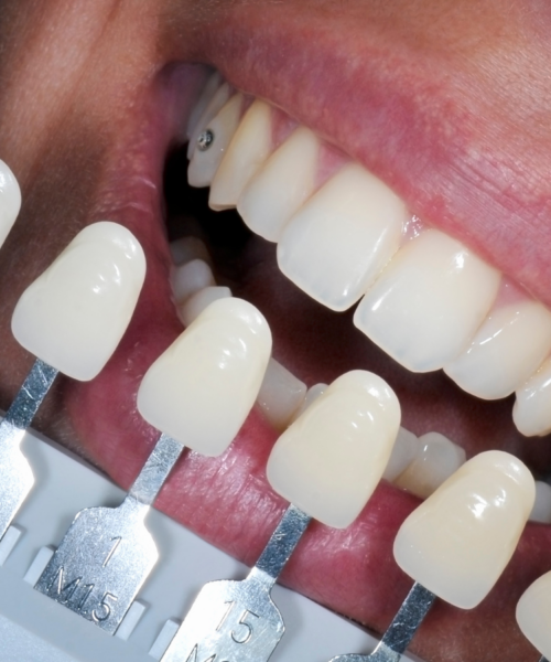 Veneers