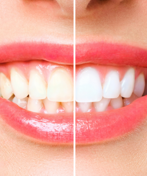 Teeth-Whitening