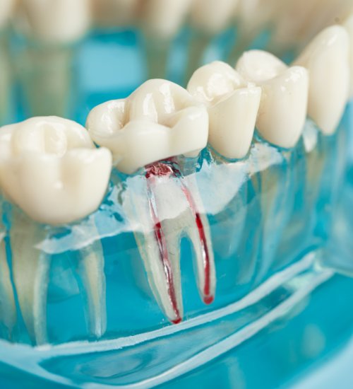 Root canal