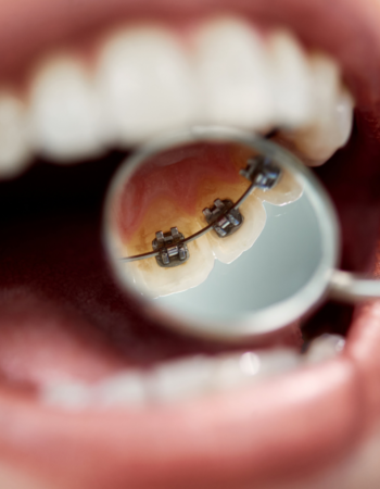 lingual braces